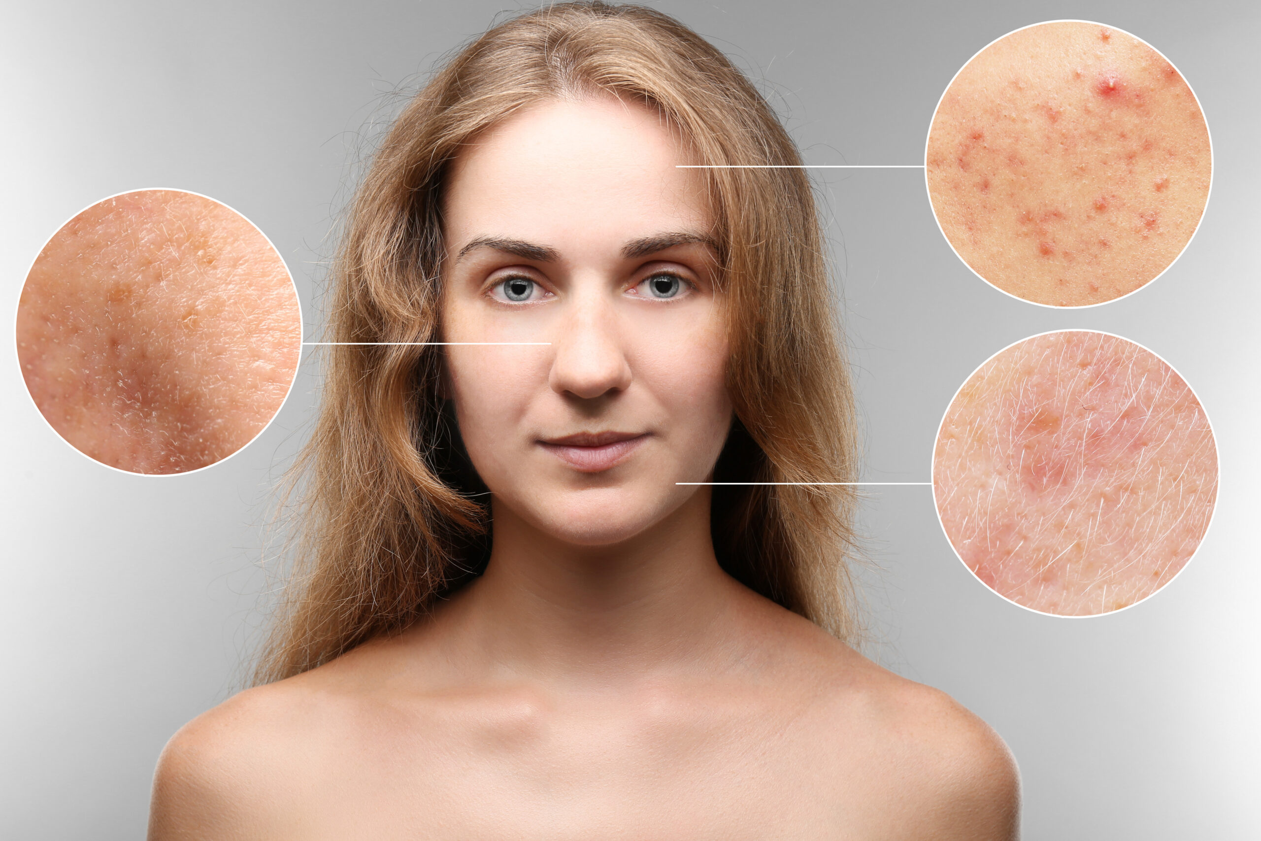 Why Microneedling Is One of the Best Treatments for Acne Scars and Skin Texture | ABR Aesthetics in Franklin, TN